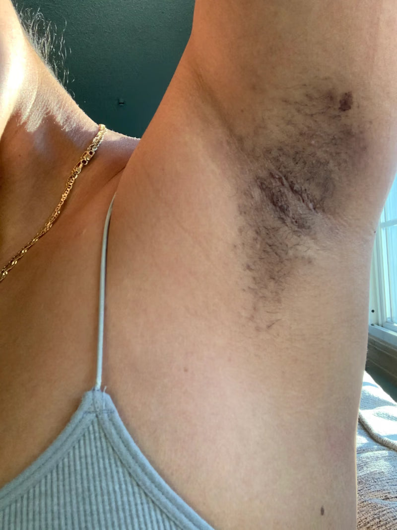 Acanthosis Nigricans